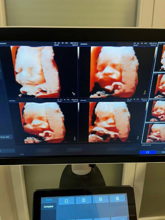 Használt HS40 ultrahang készülék négy vizsgálófejjel szülészeti, nőgyógyászati és radiológiai célra